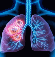 Lung Cancer Analytics Dashboard
